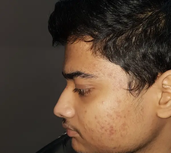 After Acne & Acne Scar Treatment result