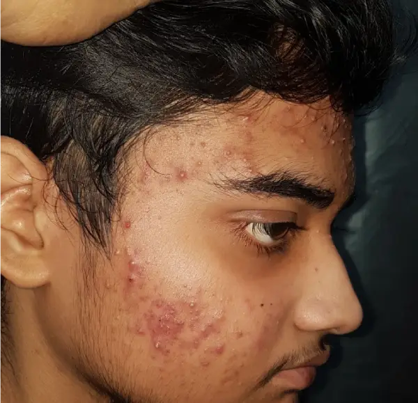 Before Acne & Acne Scar Treatment result
