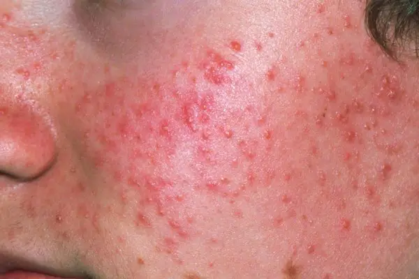Acne & Acne Scar Treatment at DTC Skin Clinic