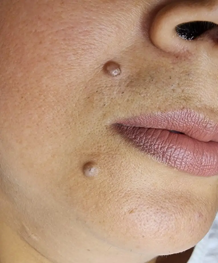 Before Wart Removal result